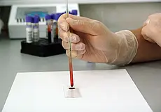 За 2022 год ВИЧ-инфекцией заразилось 173 жителя Могилевской области