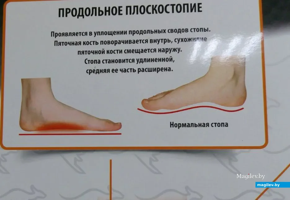Плакат о плоскостопии в детской поликлинике. Фото автора.
