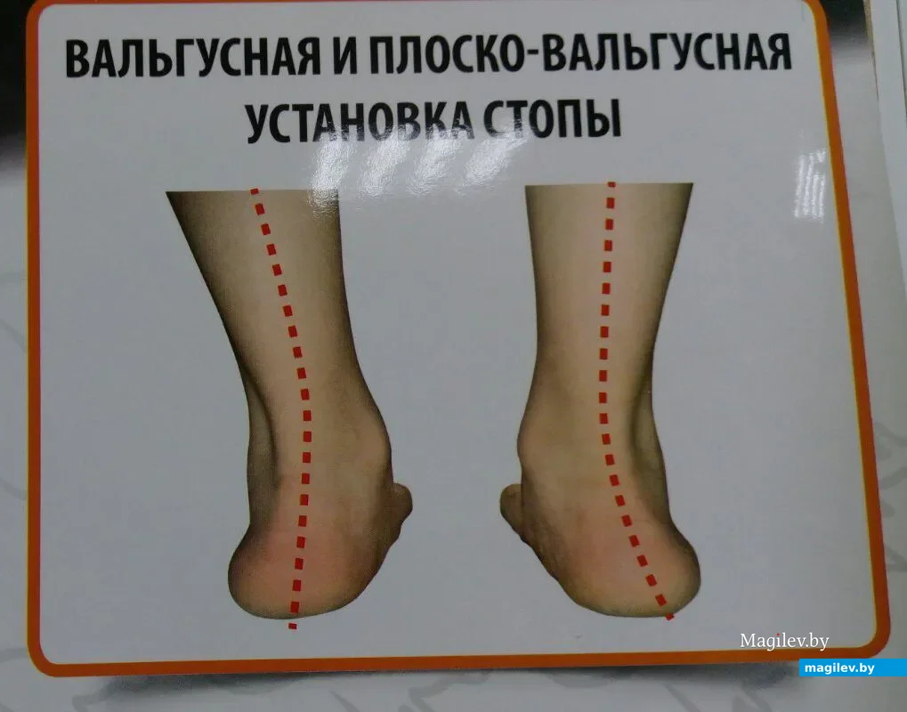 Плакат о плоскостопии в детской поликлинике. Фото автора.