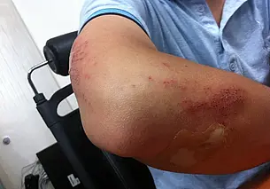 Гематомы на теле – почему их нельзя игнорировать, рассказывает доктор