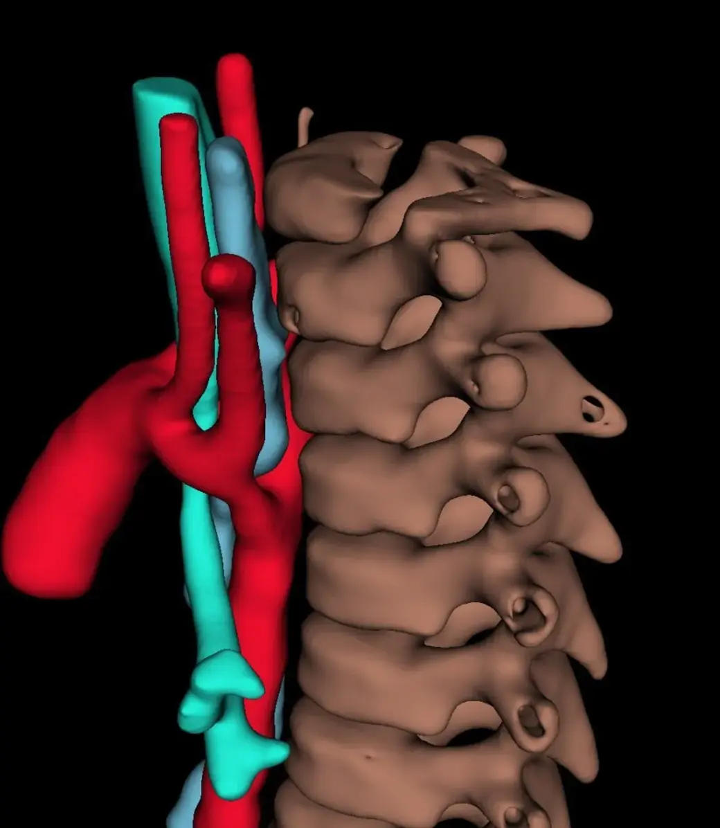 На базе РНПЦ детской хирургии впервые в Беларуси выполнено торакоскопическое рассечение аортального кольца у пациента с врожденным пороком развития – двойной дугой