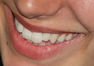 3 продукта, которые вредят зубам: что никогда не положит в рот стоматолог