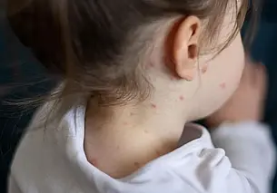 В Лидском районе подтвержден случай кори. У 15 человек заболевание заподозрено