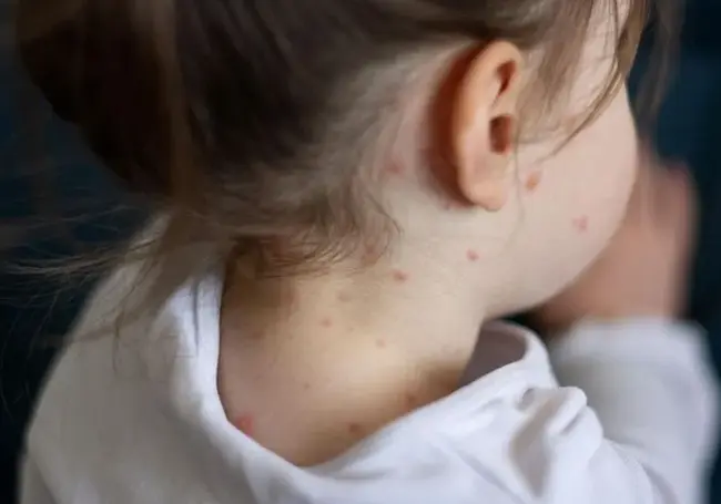 В Лидском районе подтвержден случай кори. У 15 человек заболевание заподозрено