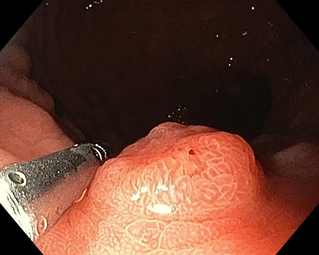 Во время колоноскопии обнаружен полип в толстом кишечнике.