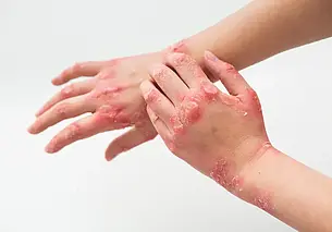 В Осиповичах восьмимесячный ребенок получил ожоги 40% тела