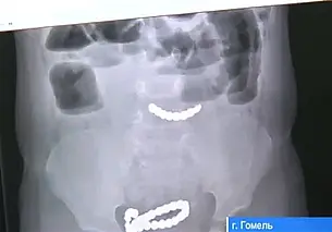 Из желудка 2-летнего ребенка гомельские врачи достали 20 магнитов