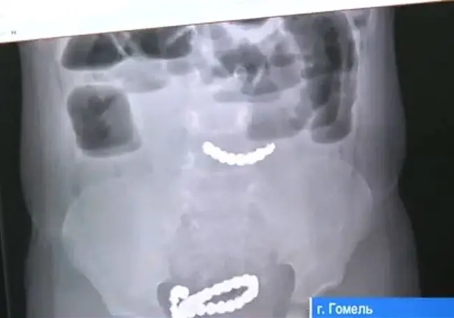 Из желудка 2-летнего ребенка гомельские врачи достали 20 магнитов