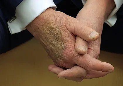 У Дональда Трампа диагностировано хроническое заболевание