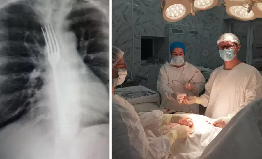 Вилка застряла в пищеводе женщины. Фото: Витебская областная клиническая больница.