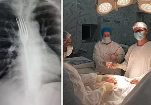 В Витебске врачи достали вилку из пищевода пациентки