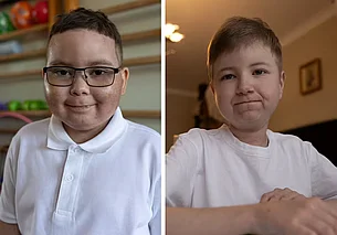 Цена улыбки: как новейшая медицина и милосердие белорусов помогают Жене и Ване